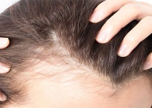 8 روش کاشت مو – مزایا و معایب