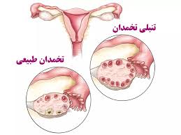 تفاوت تنبلی تخمدان و کیست تخمدان چیست؟