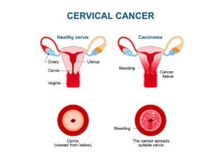 ویروس HPV چیست؟