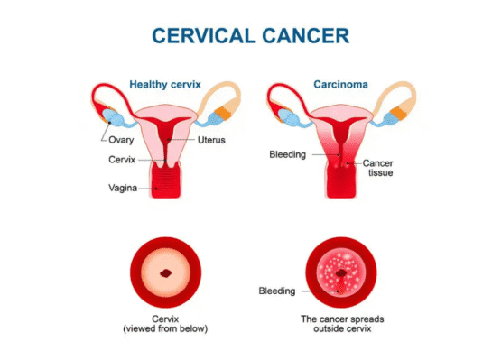 ویروس HPV چیست؟